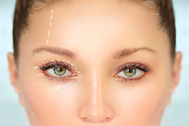 Blepharoplasty