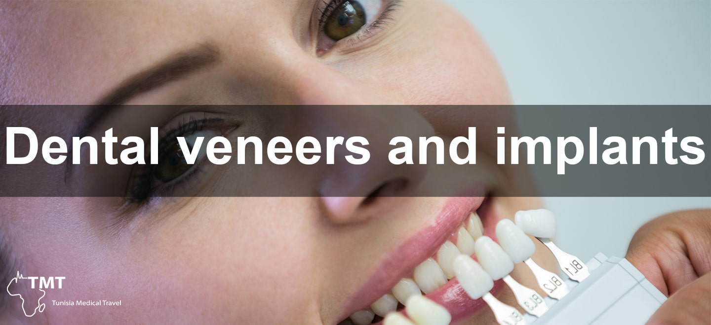 Dental veneers and implants