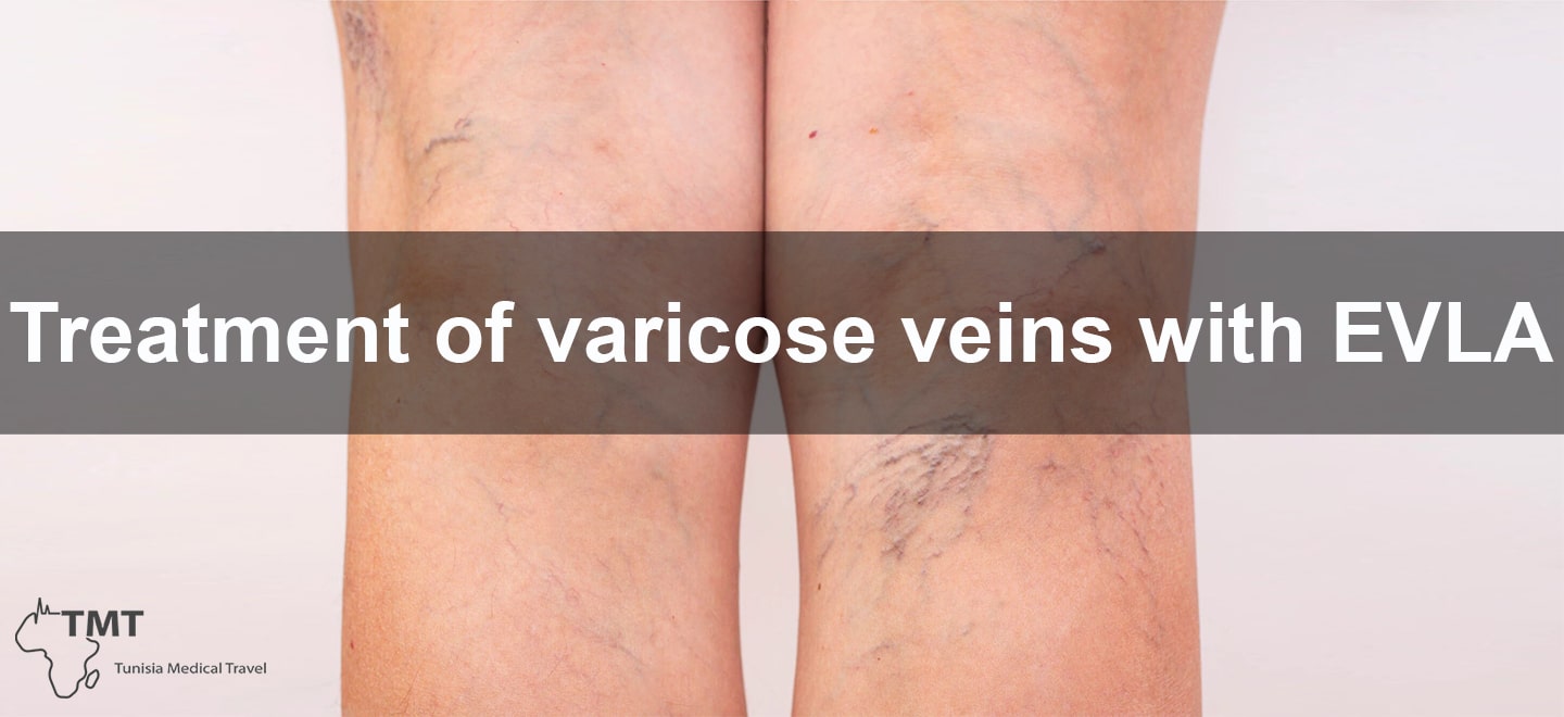 Treatment of varicose veins with EVLA