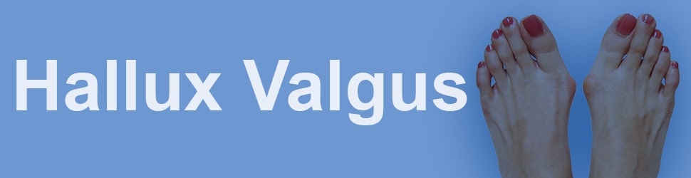 Hallux Valgus