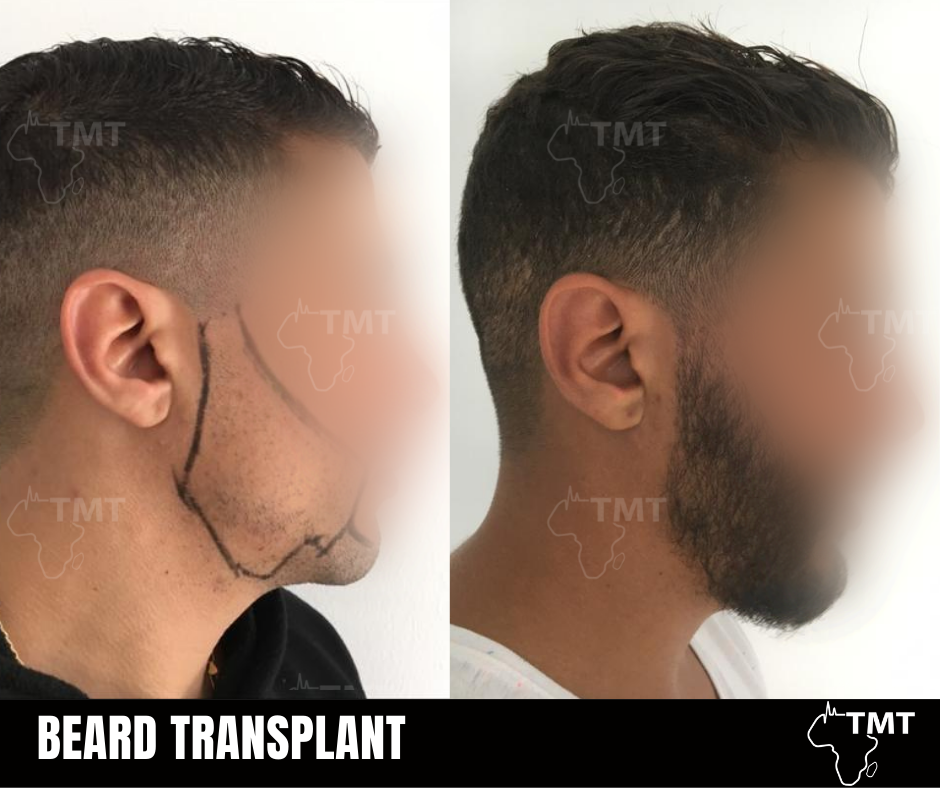 beard transplant 2