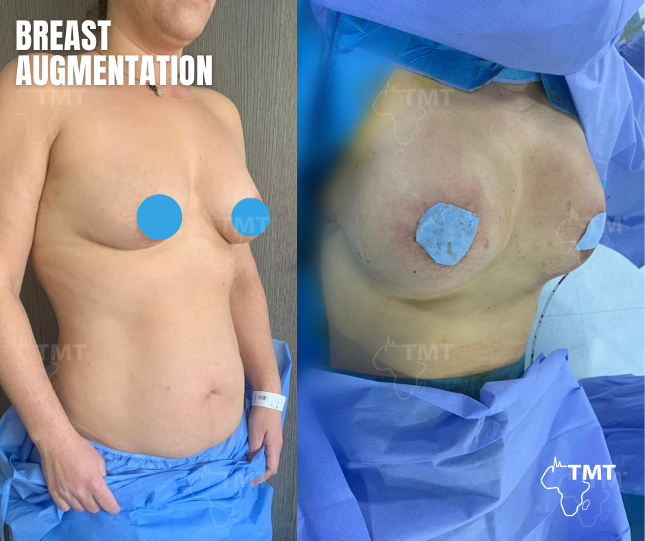 breast augmentation before after 2
