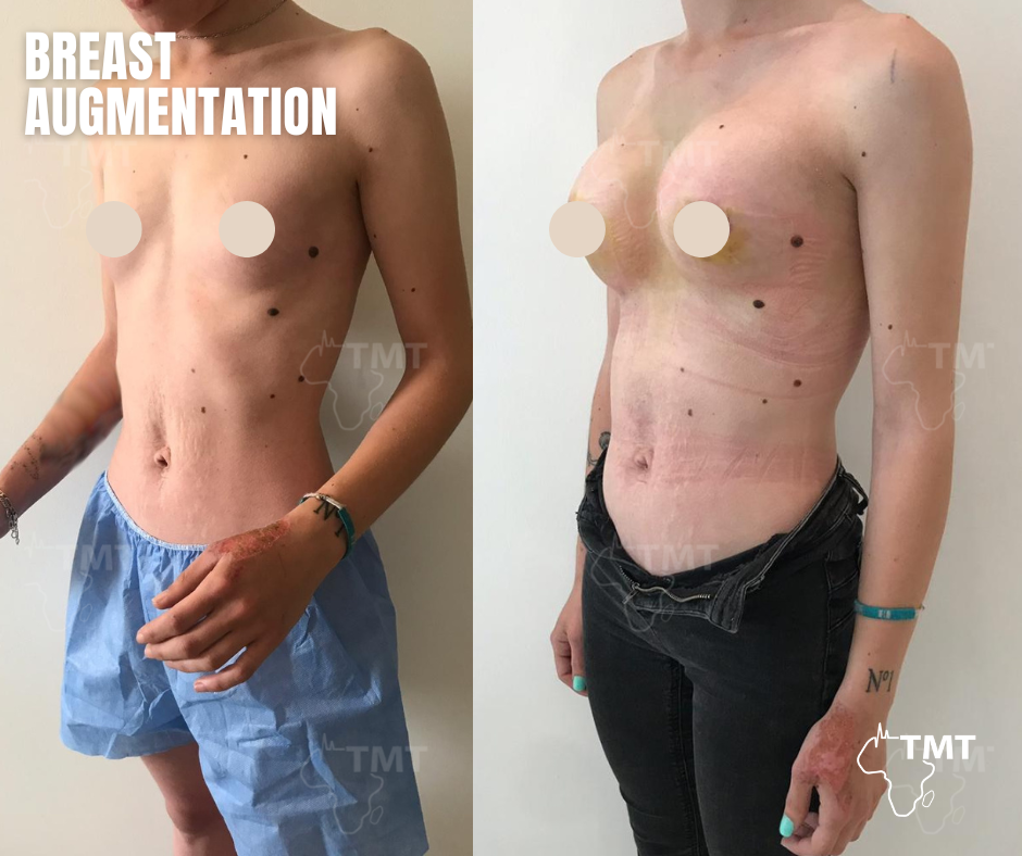 breast augmentation before after 6