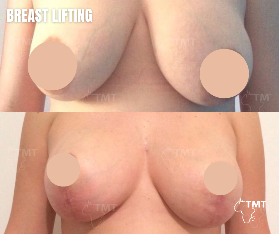 breast lift 12