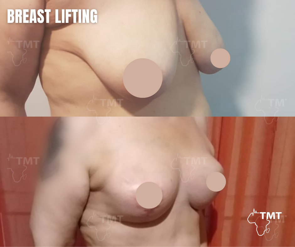breast lift 13