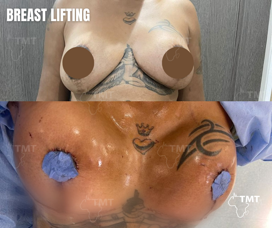 breast lift 14