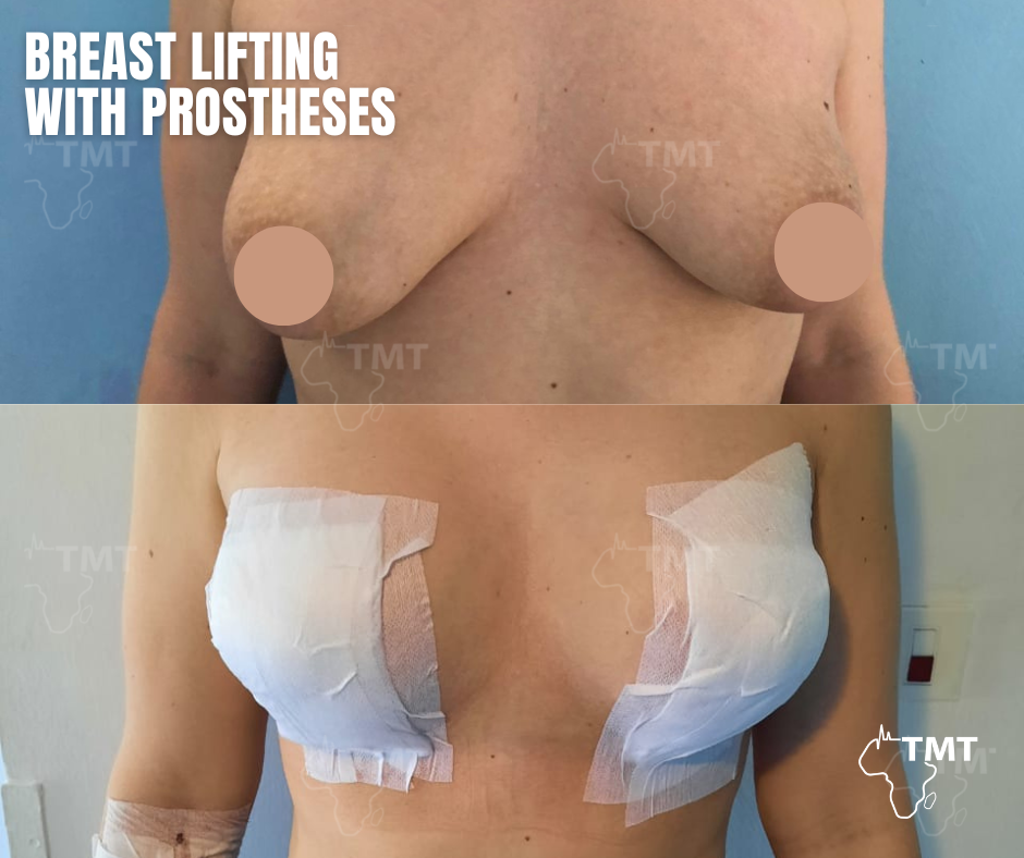 breast lift 2