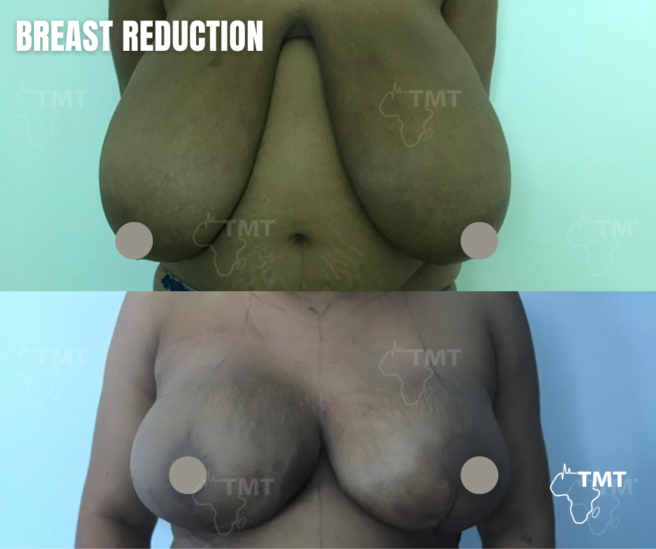 breast réduction before after 2