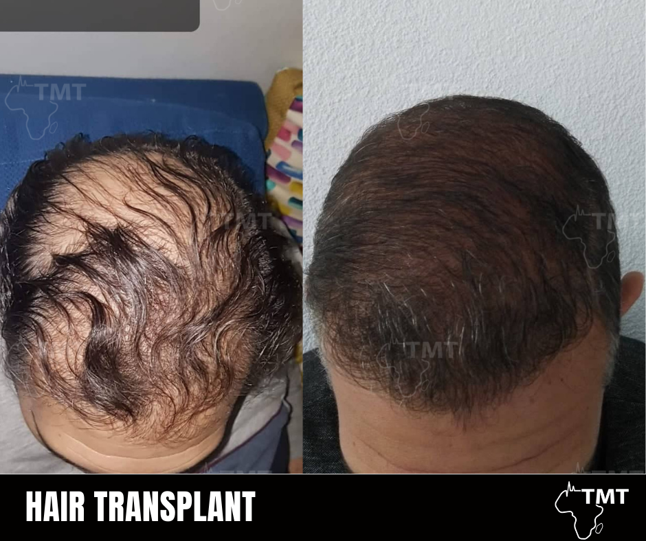 hair transplant before after 10