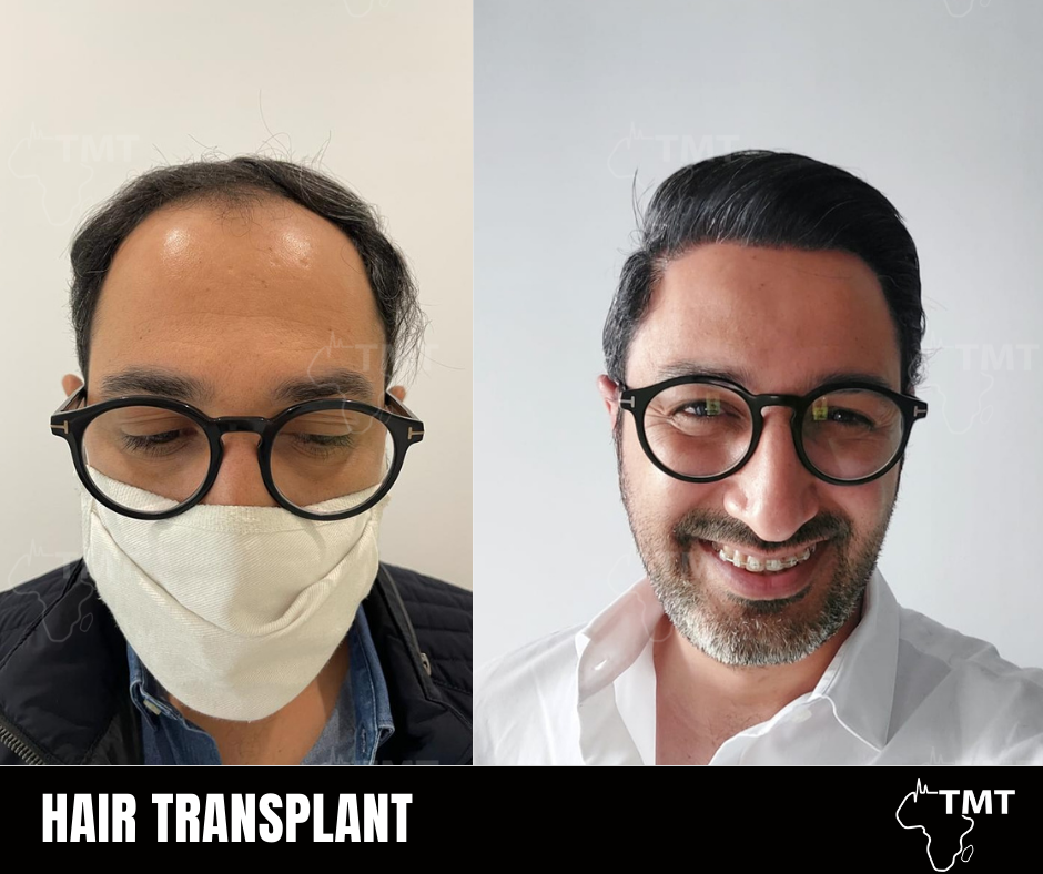 hair transplant before after 11
