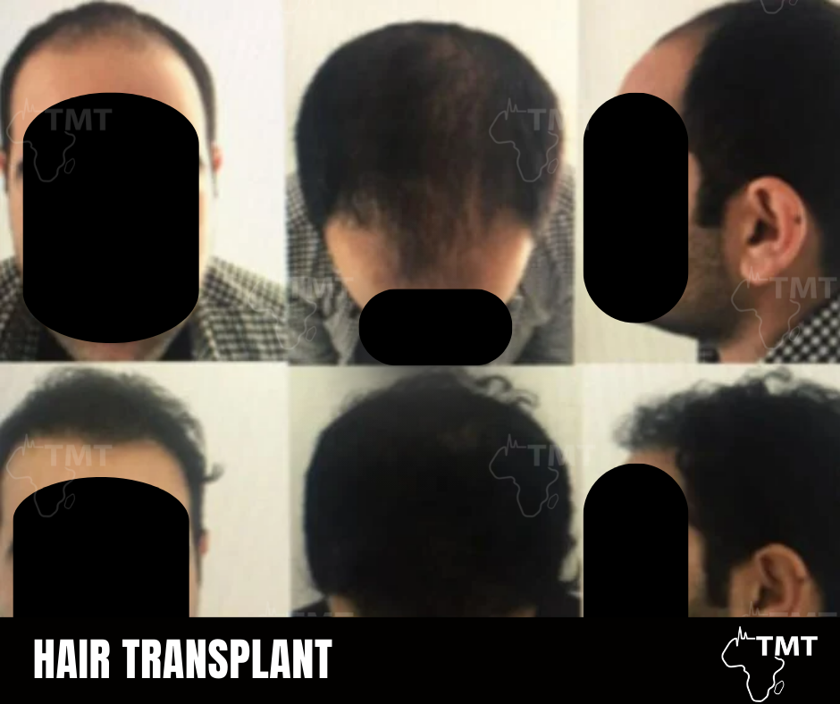 hair transplant before after 12