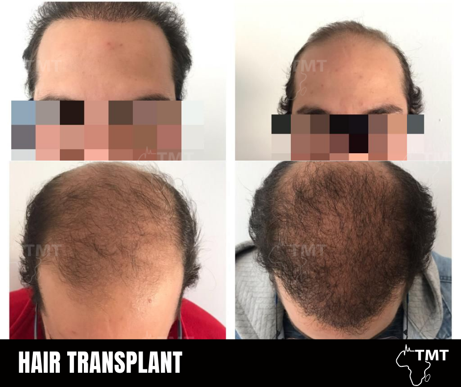 hair transplant before after 13