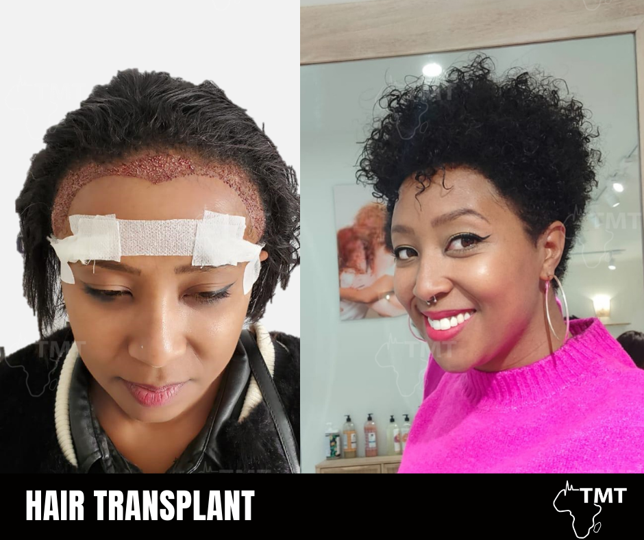 hair transplant before after 14