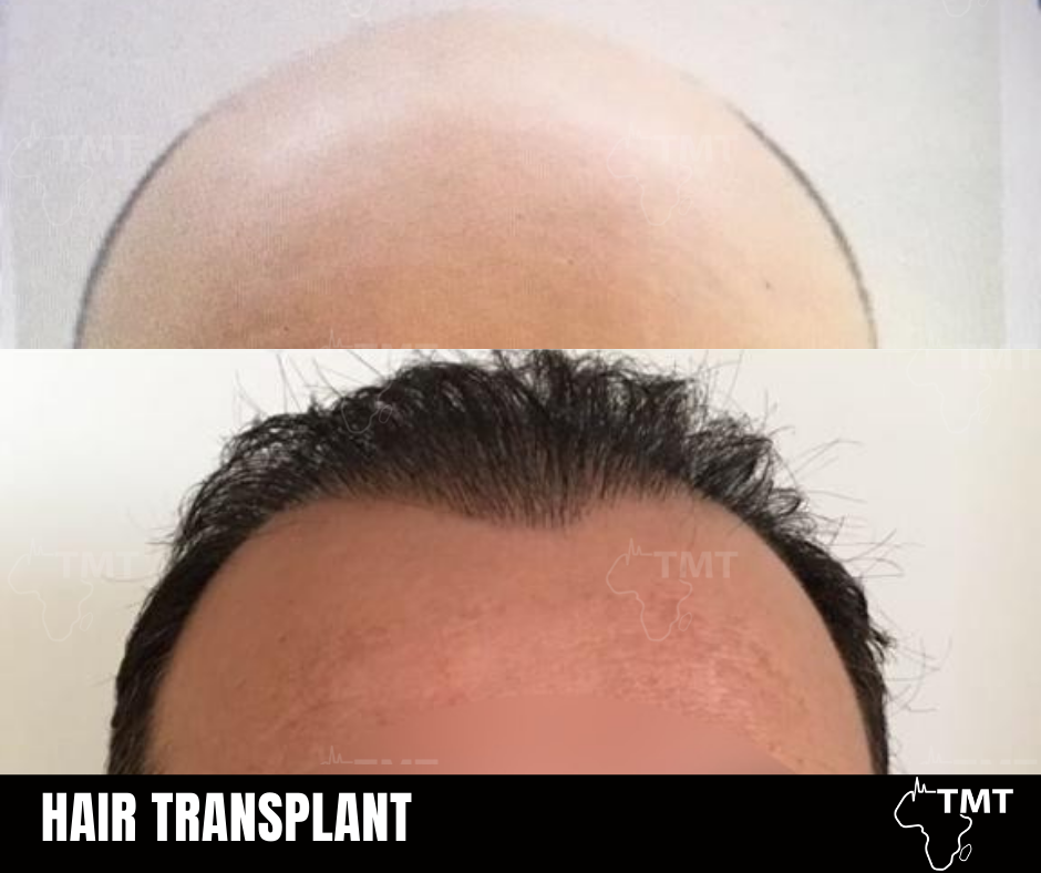 hair transplant before after 2