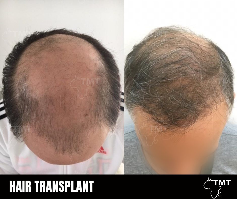 hair transplant before after 4
