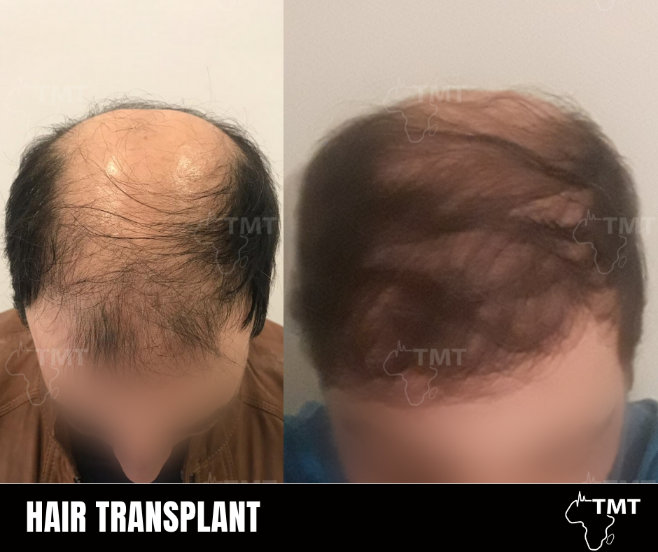 hair transplant before after 8
