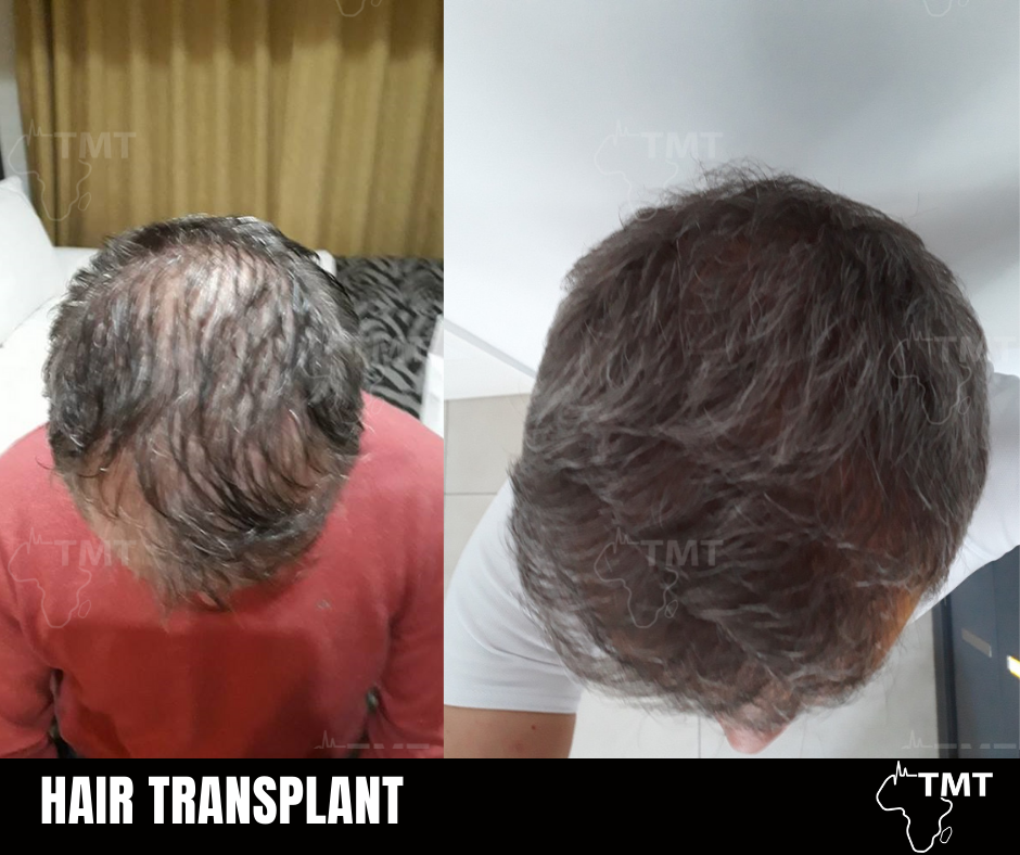 hair transplant before after 9