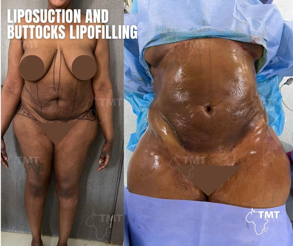 liposuction 2