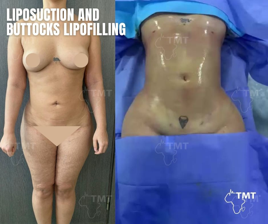 liposuction 11