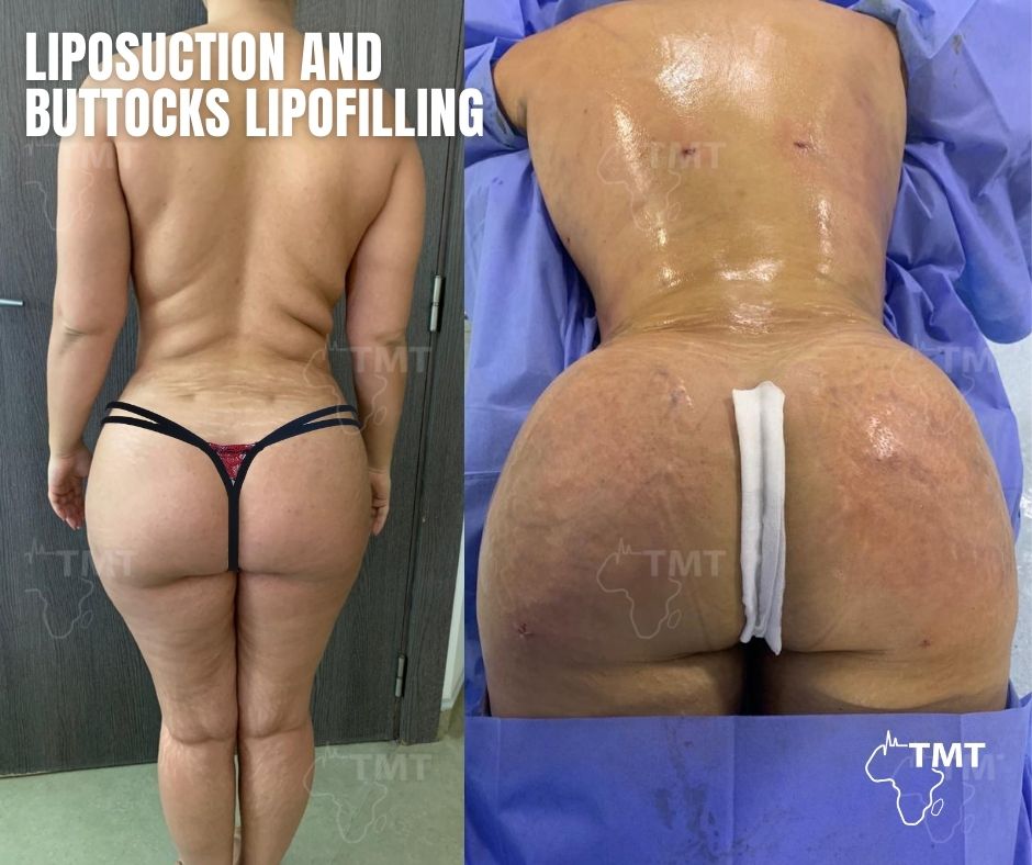 liposuction 12