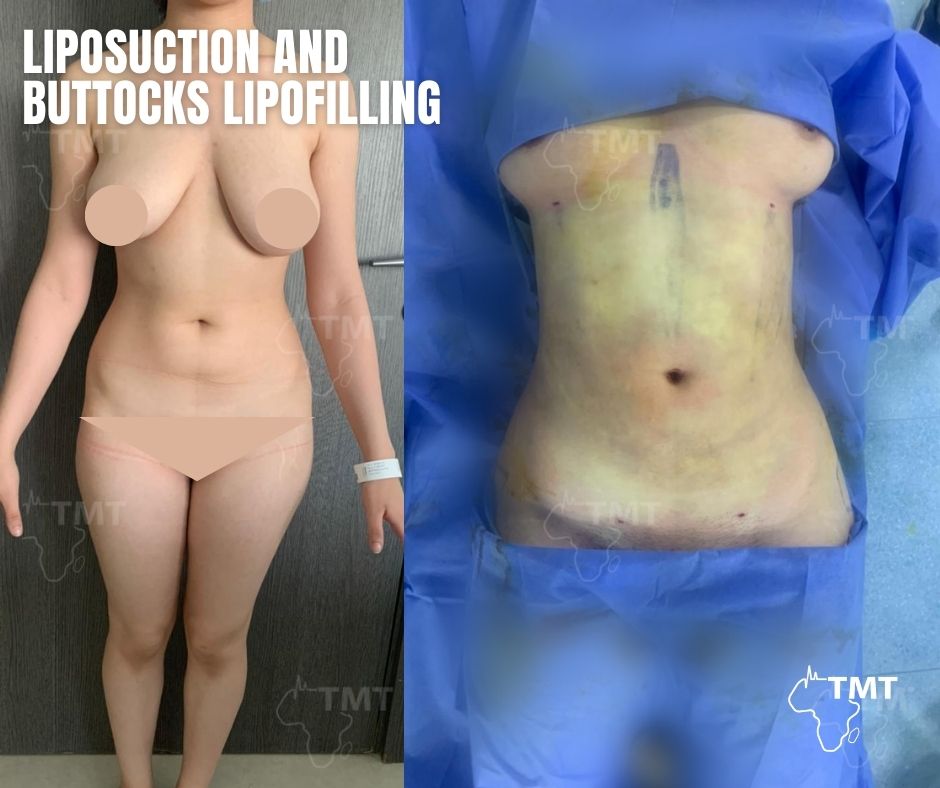 liposuction 13