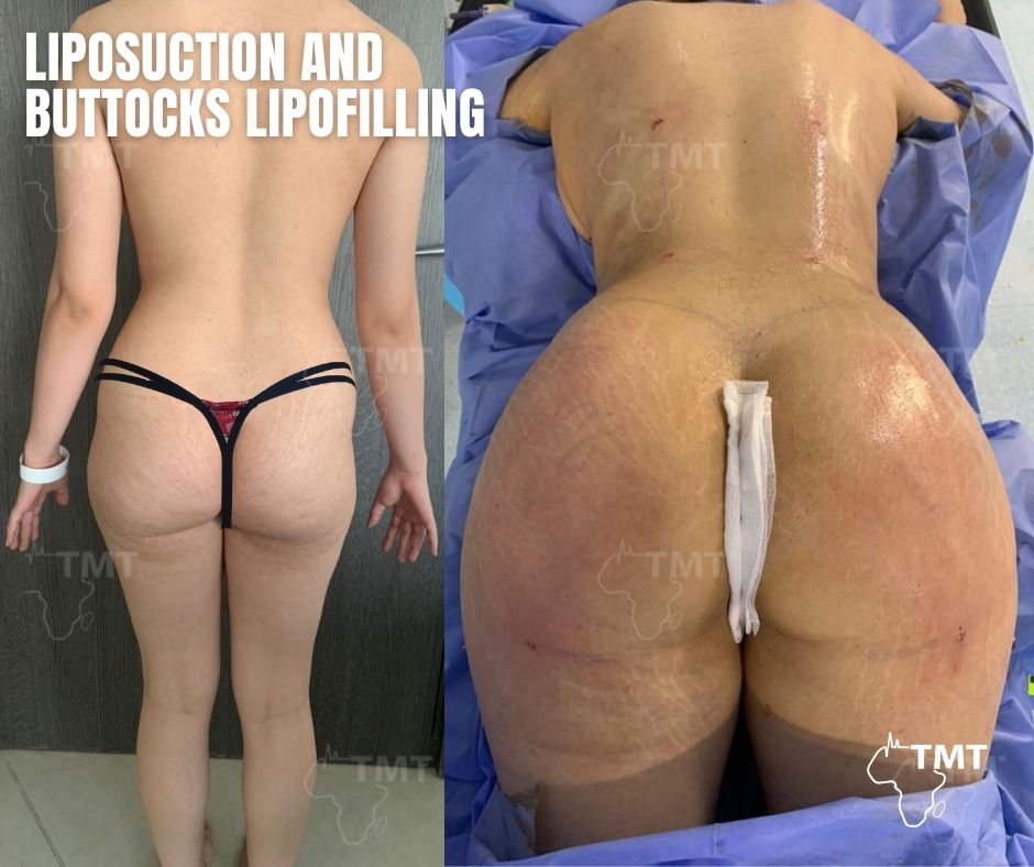liposuction 14