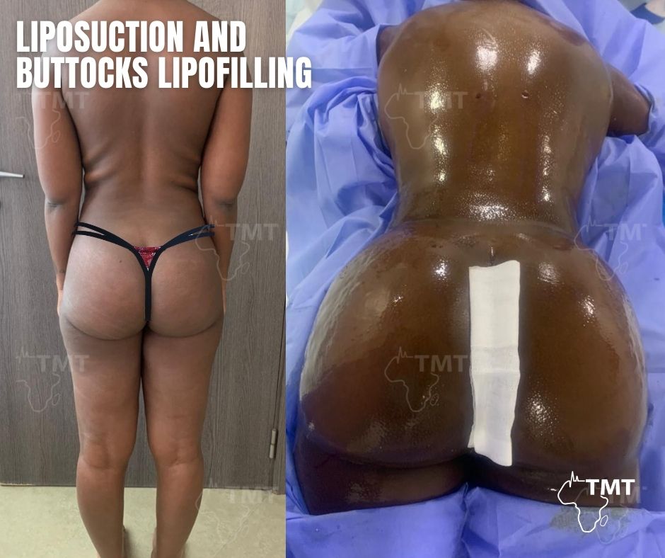 liposuction 16
