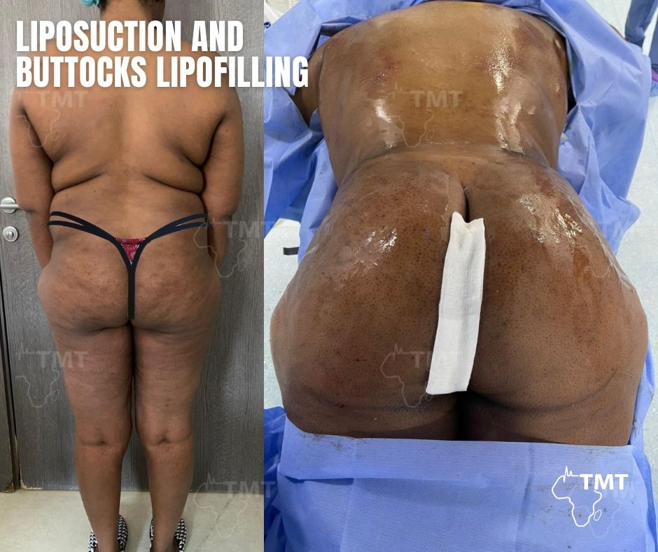 liposuction 17