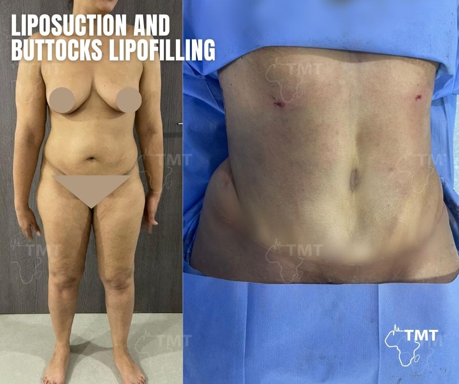 liposuction 18