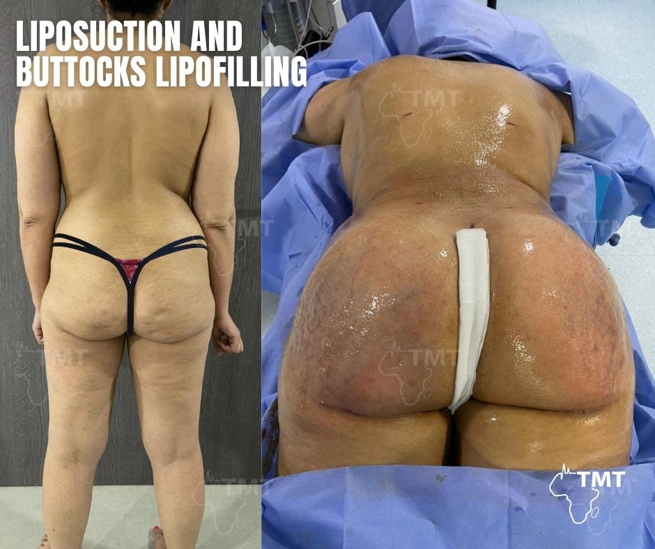 liposuction 19