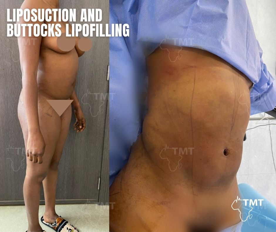 liposuction 20