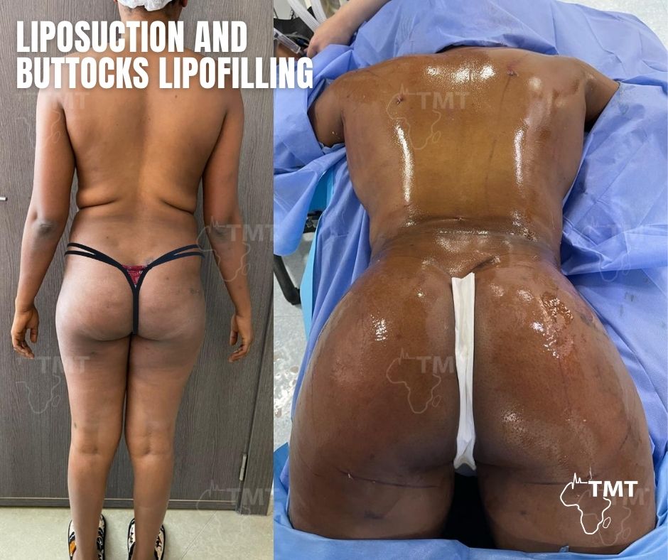 liposuction 21