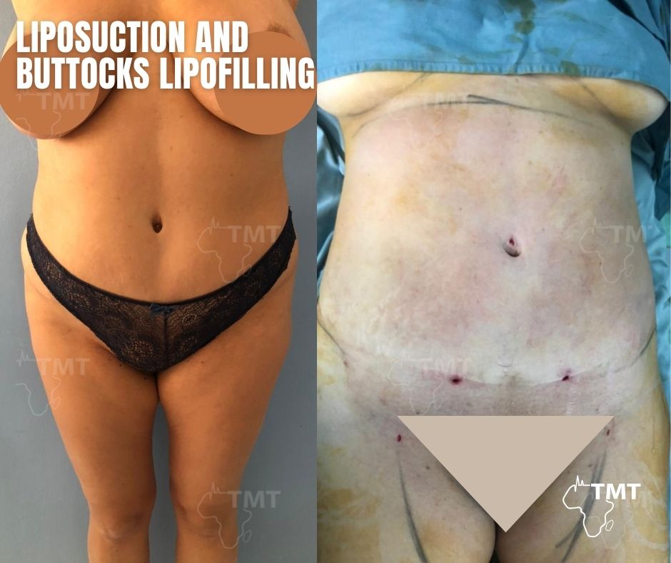 liposuction 22
