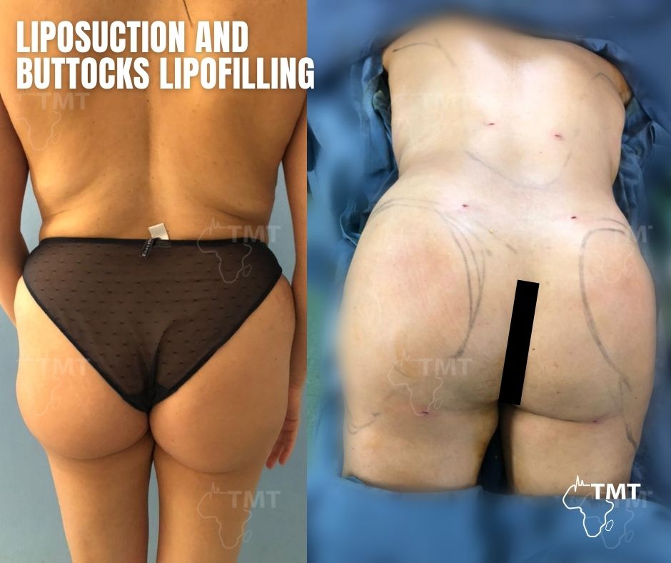 liposuction 23