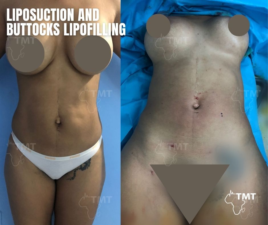 liposuction 24