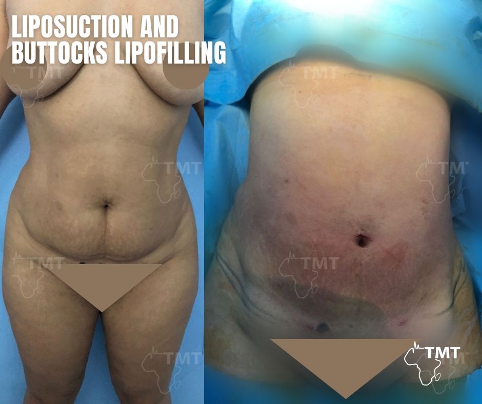 liposuction 26