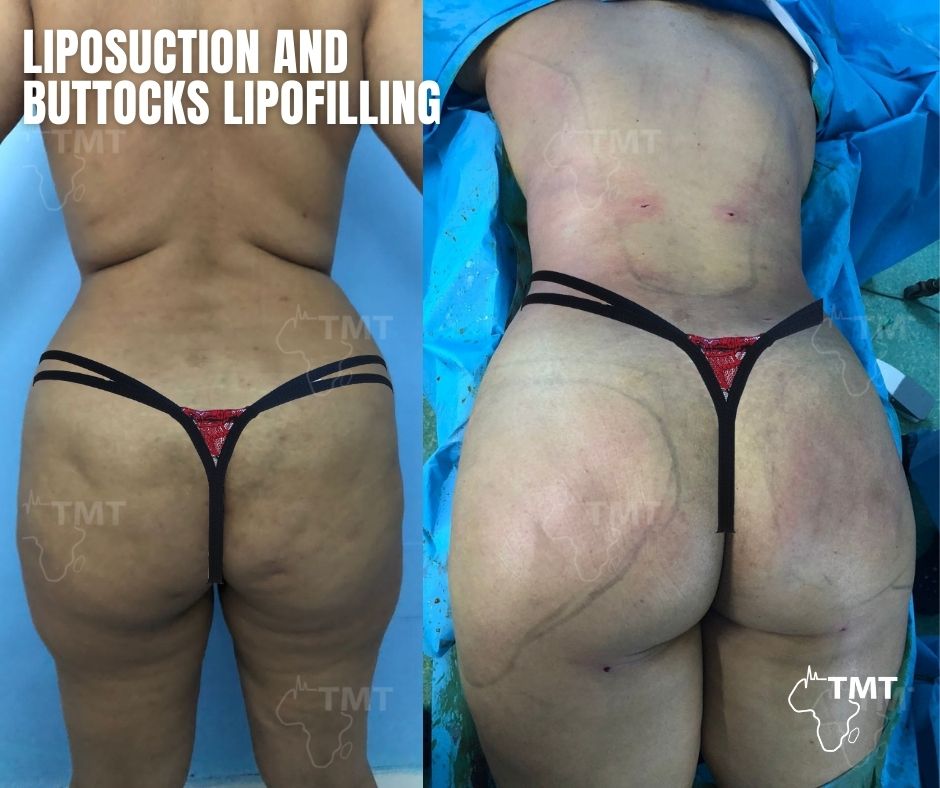 liposuction 27