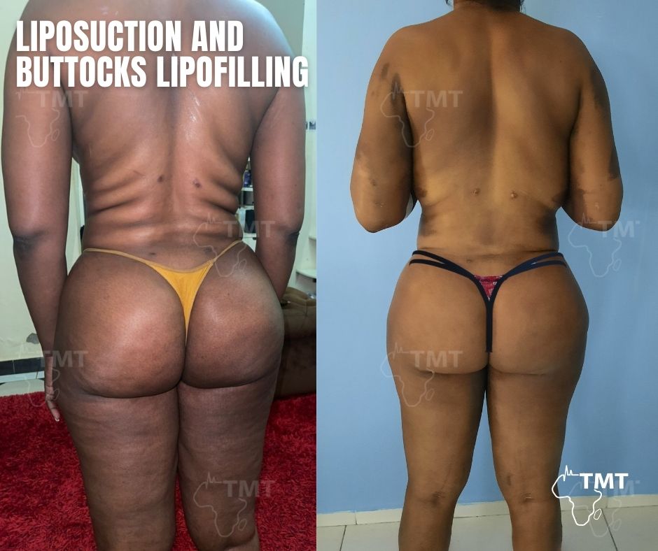liposuction 29