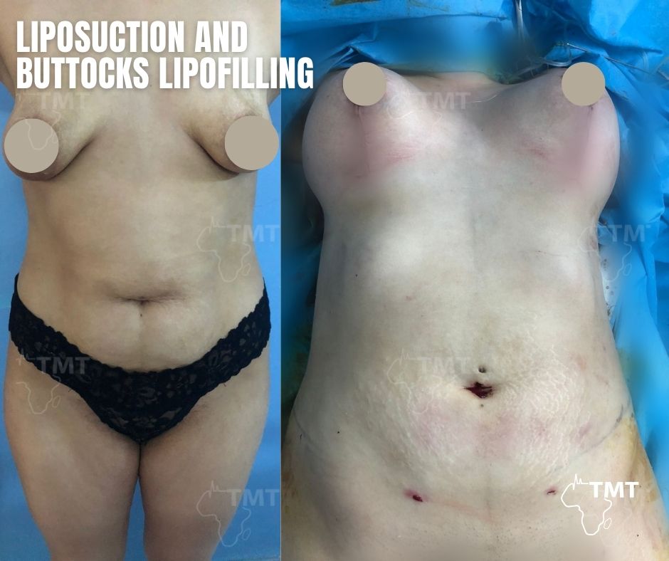 liposuction 30