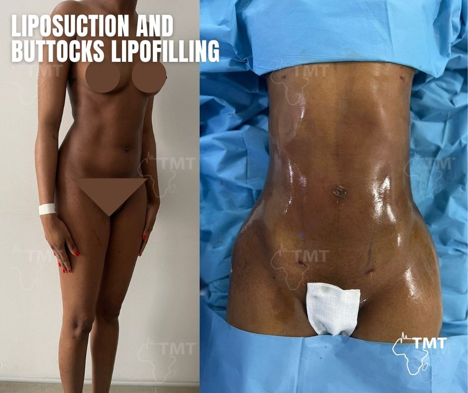 liposuction 32