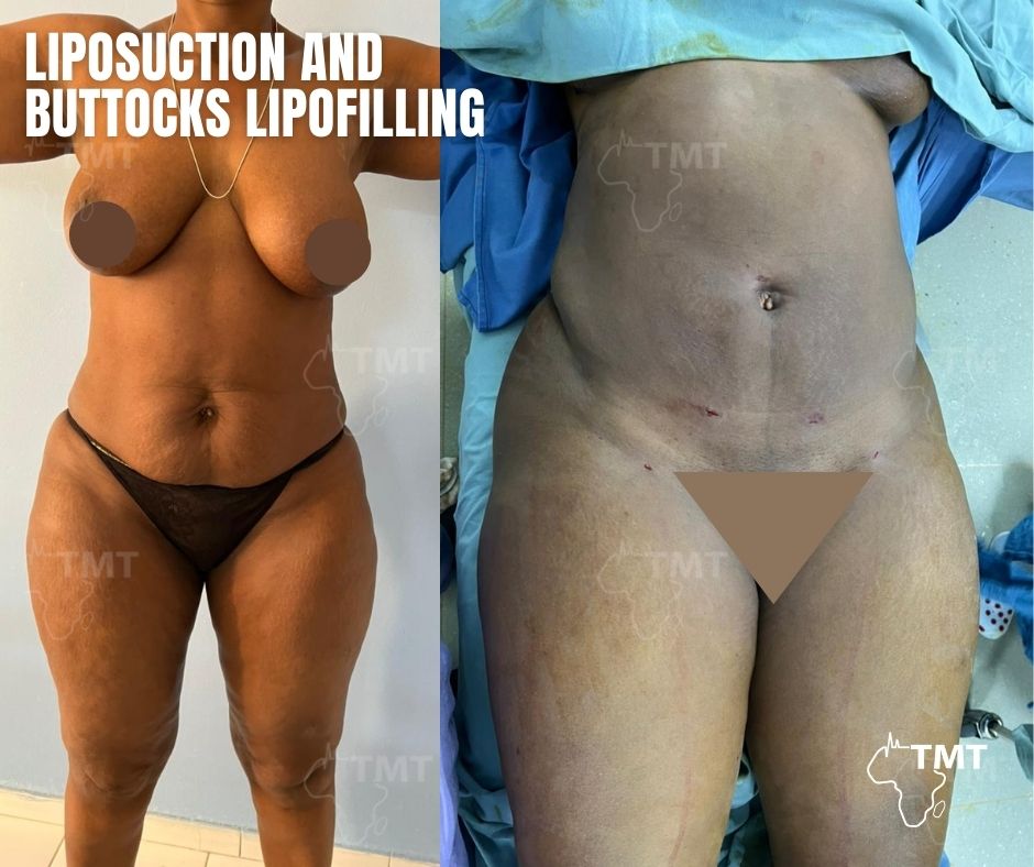 liposuction 34