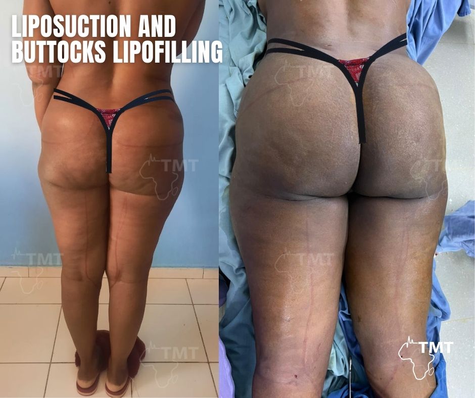 liposuction 35