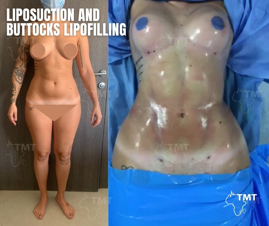 liposuction 36