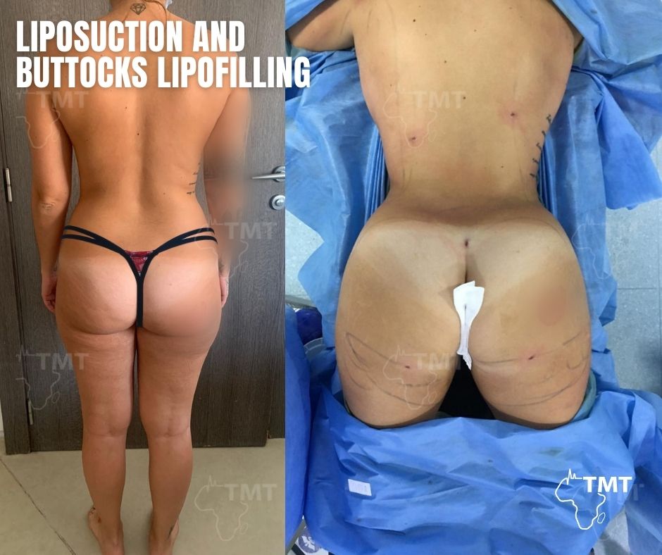 liposuction 37