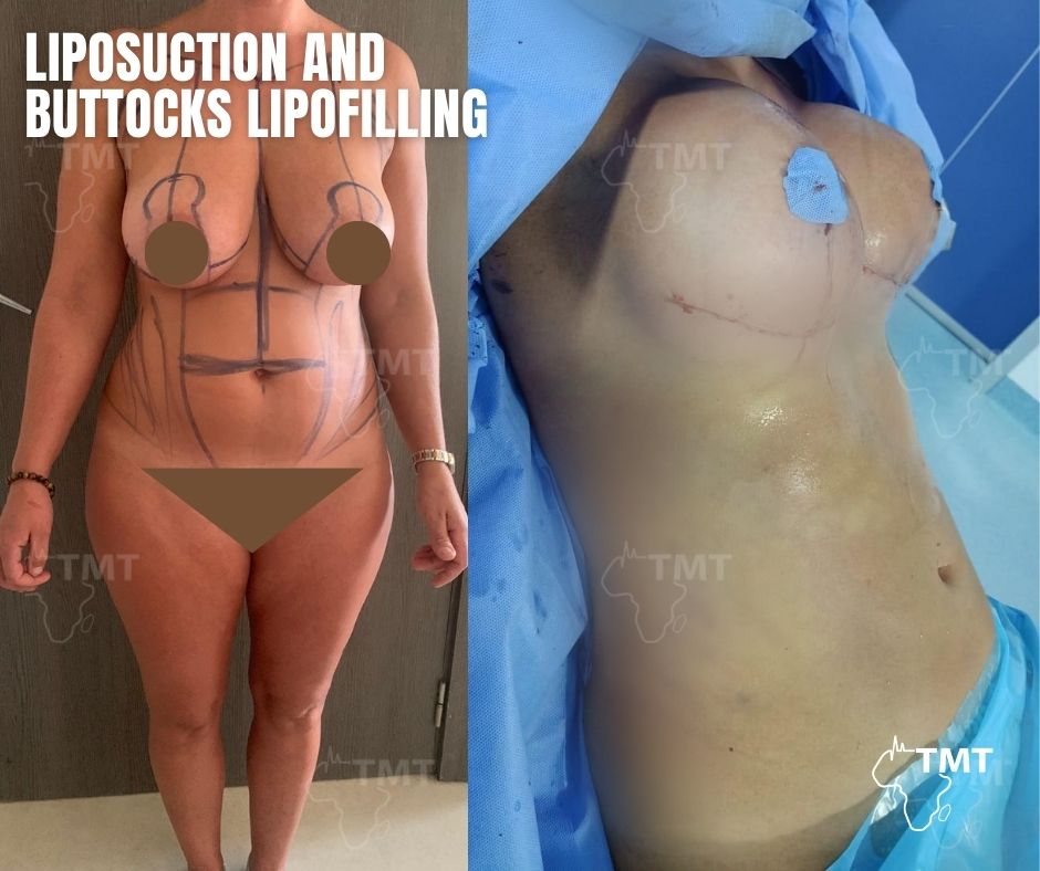 liposuction 38