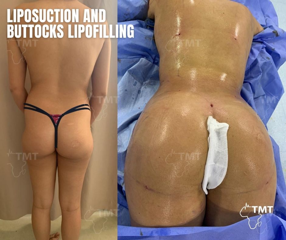 liposuction 4