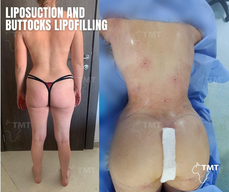 liposuction 41