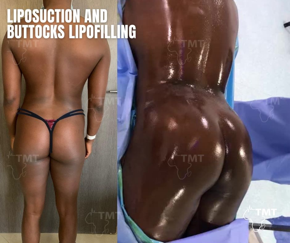 liposuction 42