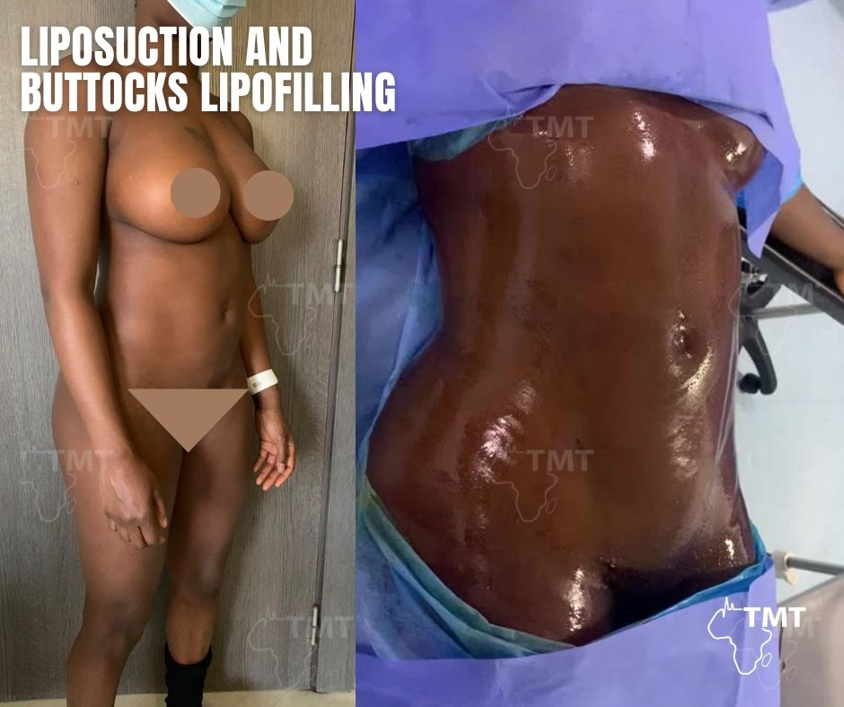 liposuction 43
