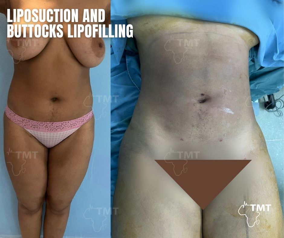 liposuction 44